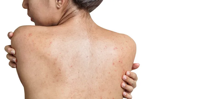 Як боротися з акне на спині? Таємниці боротьби з акне на спині: Як досягти чистої шкіри